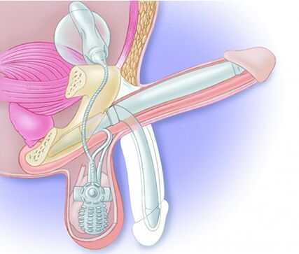 Una protesi peniena ripristina l’erezione e allarga il pene