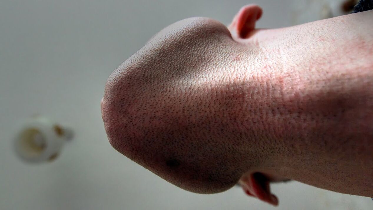 Alcuni prodotti per l’ingrandimento del pene possono causare allergie