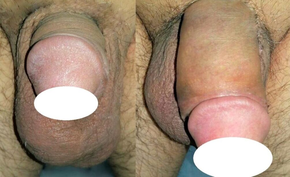 Foto prima e dopo l'ingrandimento del pene